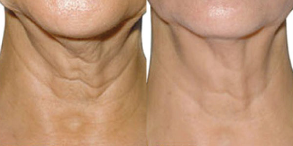 Before and after photo